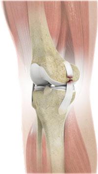 Medial Collateral Ligament Tear in Adults