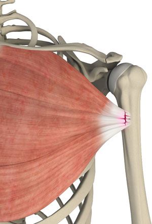 Pectoralis Tendon Rupture