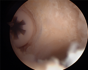 ACL Reconstruction absorbs into the bone over time with no permanent implant Image