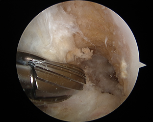 ACL Reconstruction