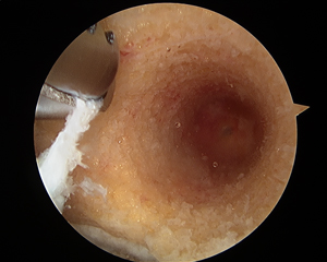 ACL Reconstruction