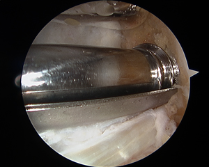 ACL Reconstruction