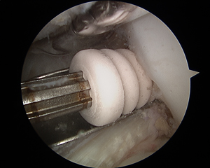 ACL Reconstruction