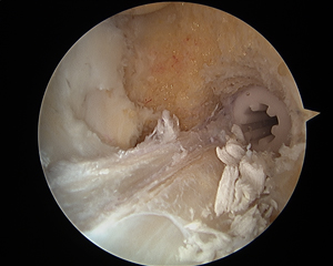 ACL Reconstruction