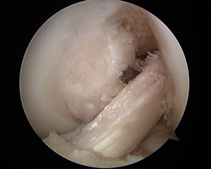 ACL Reconstruction