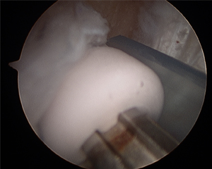 ACL Reconstruction analogous to synthetic bone Image