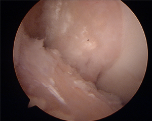 ACL BTB autograft reconstruction Image