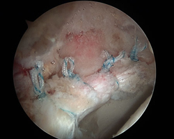  hip labral repair