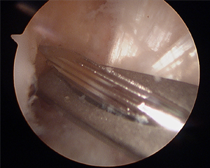 ACL Reconstruction femoral Tunnel Location Image
