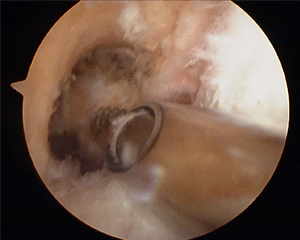 ACL Reconstruction Notchplasty After Image