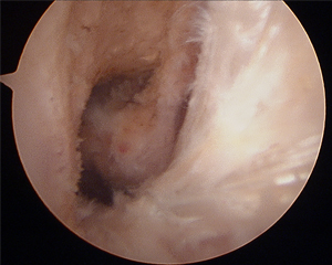 ACL Reconstruction Notchplasty Before Image