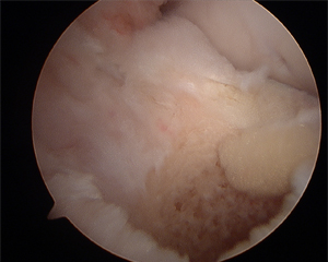 ACL Reconstruction Tibial tunnel Image