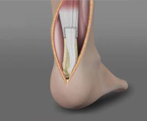 Achilles Tendon Repair