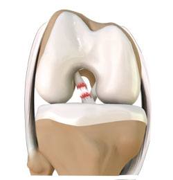 ACL Reconstruction