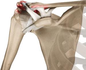 Acromioclavicular Arthritis Cincinnati