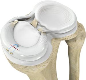 All-inside Meniscus Repair