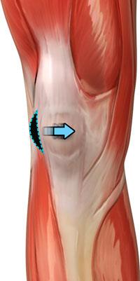 Arthroscopic Lateral Release