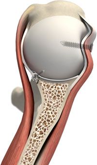 Arthroscopic Remplissage