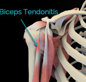 Biceps Tendonitis