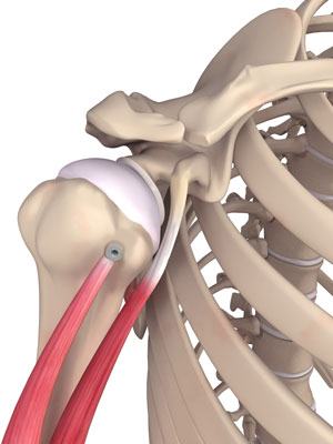 Biceps Tenotomy