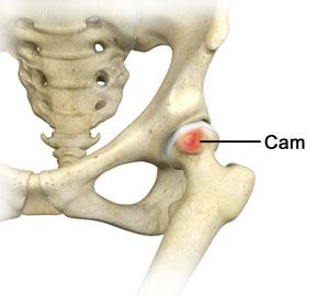 Hip microinstability in cam-type FAIS