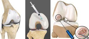 Cartilage Procedures