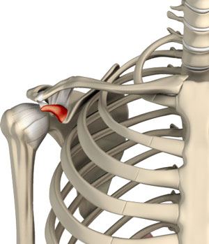 Coracoplasty