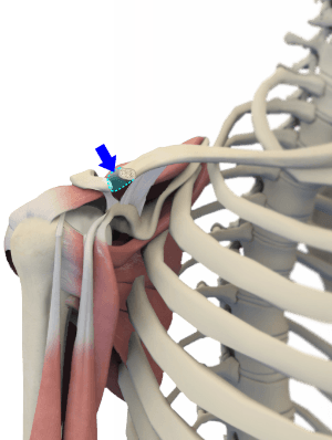 Distal Clavicle Excision