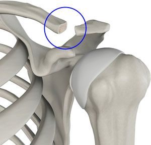 Distal Clavicle Excision