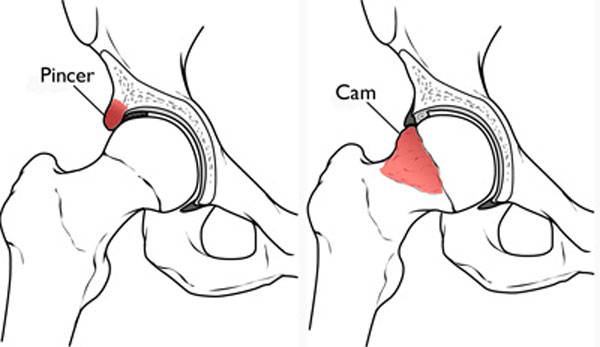 Hip microinstability in cam-type FAIS