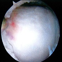 Femoroacetabular Impingement