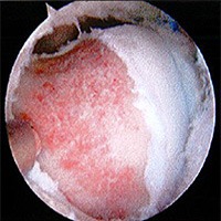 Femoroacetabular Impingement