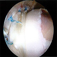 Femoroacetabular Impingement