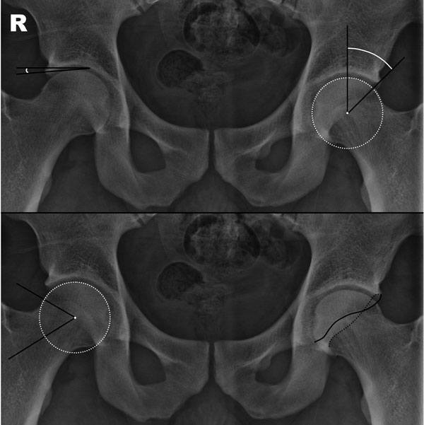 Femoroacetabular Impingement