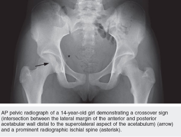 Femoroacetabular Impingement