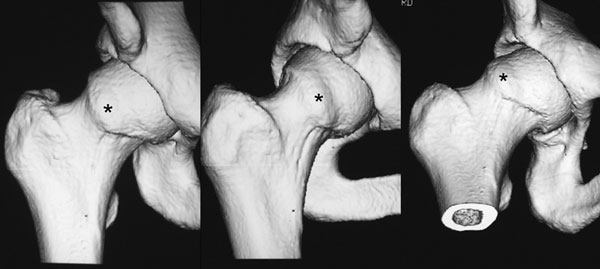 Femoroacetabular Impingement