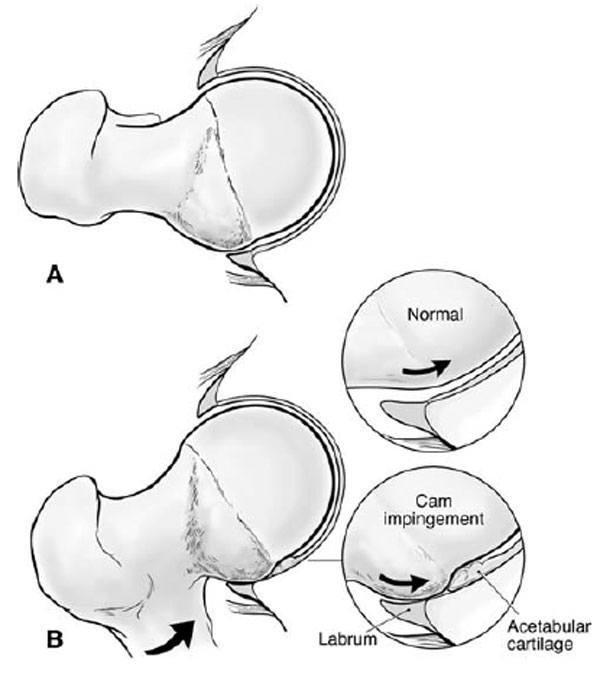 Femoroacetabular Impingement