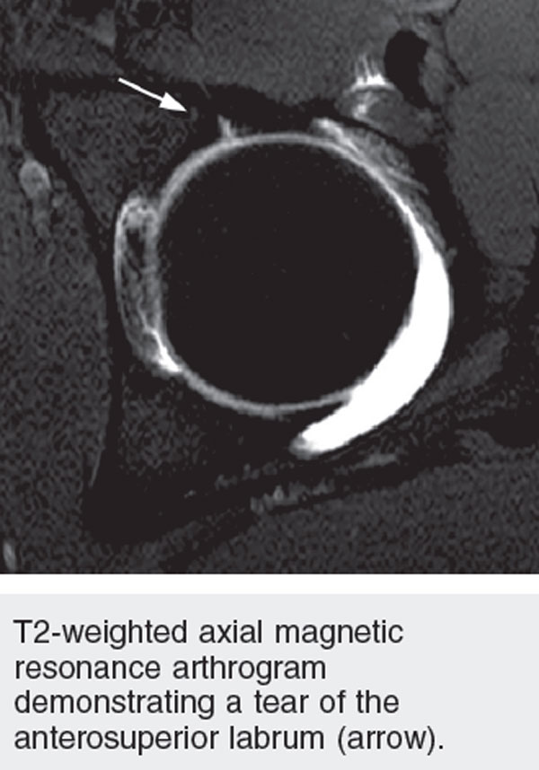 Femoroacetabular Impingement