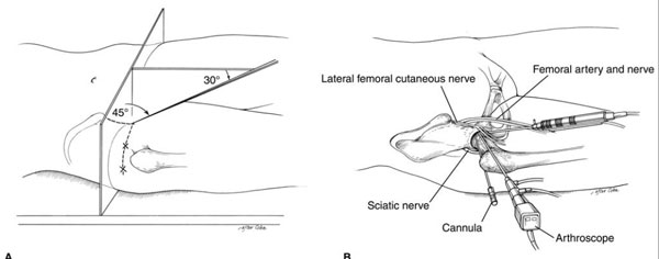 Femoroacetabular Impingement