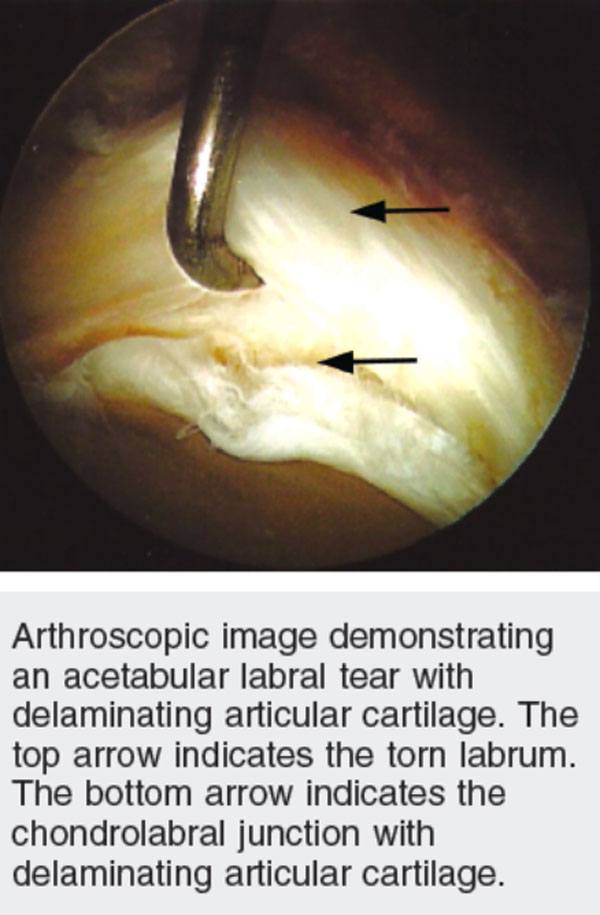 Femoroacetabular Impingement