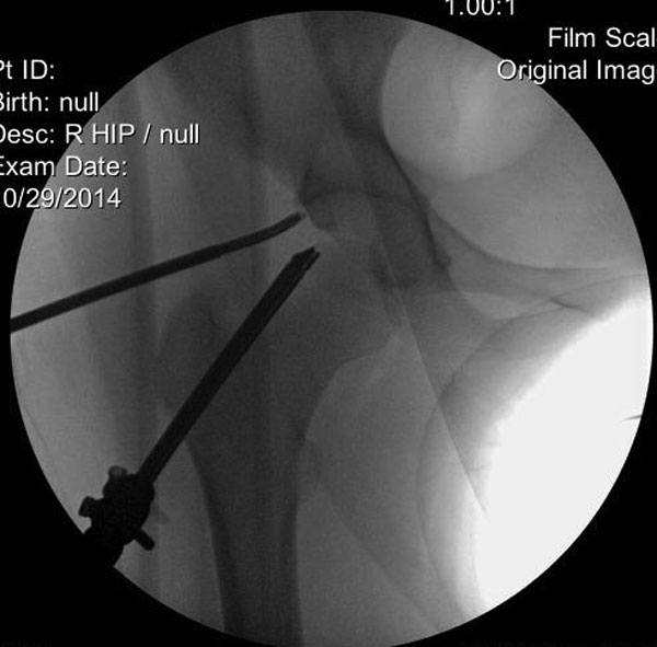 Femoroacetabular Impingement