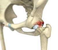 Femoroacetabular Impingement