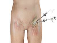 Hip Arthroscopy