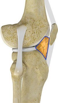 fat pad infrapatellar knee debridement patellar pain retro procedures fad anterior ii part