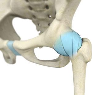 Ischiofemoral (external) Impingement