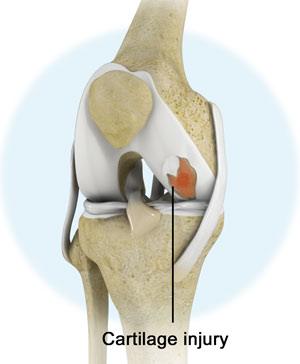 Cartilage Injury