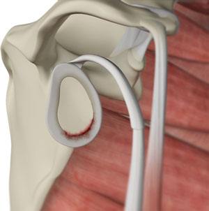 Labral Tear