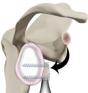 Latarjet Procedure