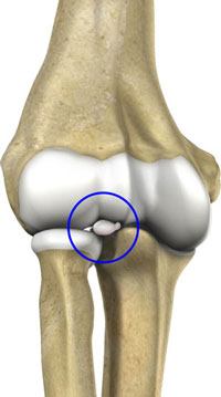 Arthrotomy Elbow