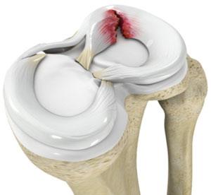 Meniscus Tear